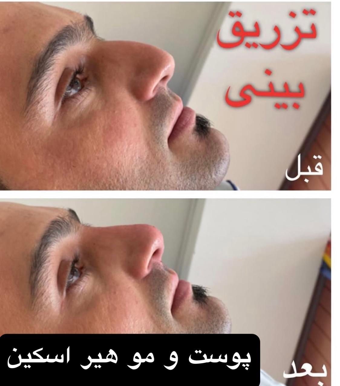 جشنواره تخفیف عیدانه تزریق ژل آنزیم جالپرو لیزر|خدمات آرایشگری و زیبایی|تهران, ستارخان|دیوار