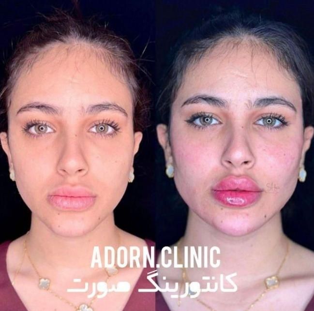 مدل فیلر لب روسی،کانتورینگ صورت،زاویه،چانه وشقیقه|خدمات آرایشگری و زیبایی|تهران, صادقیه|دیوار