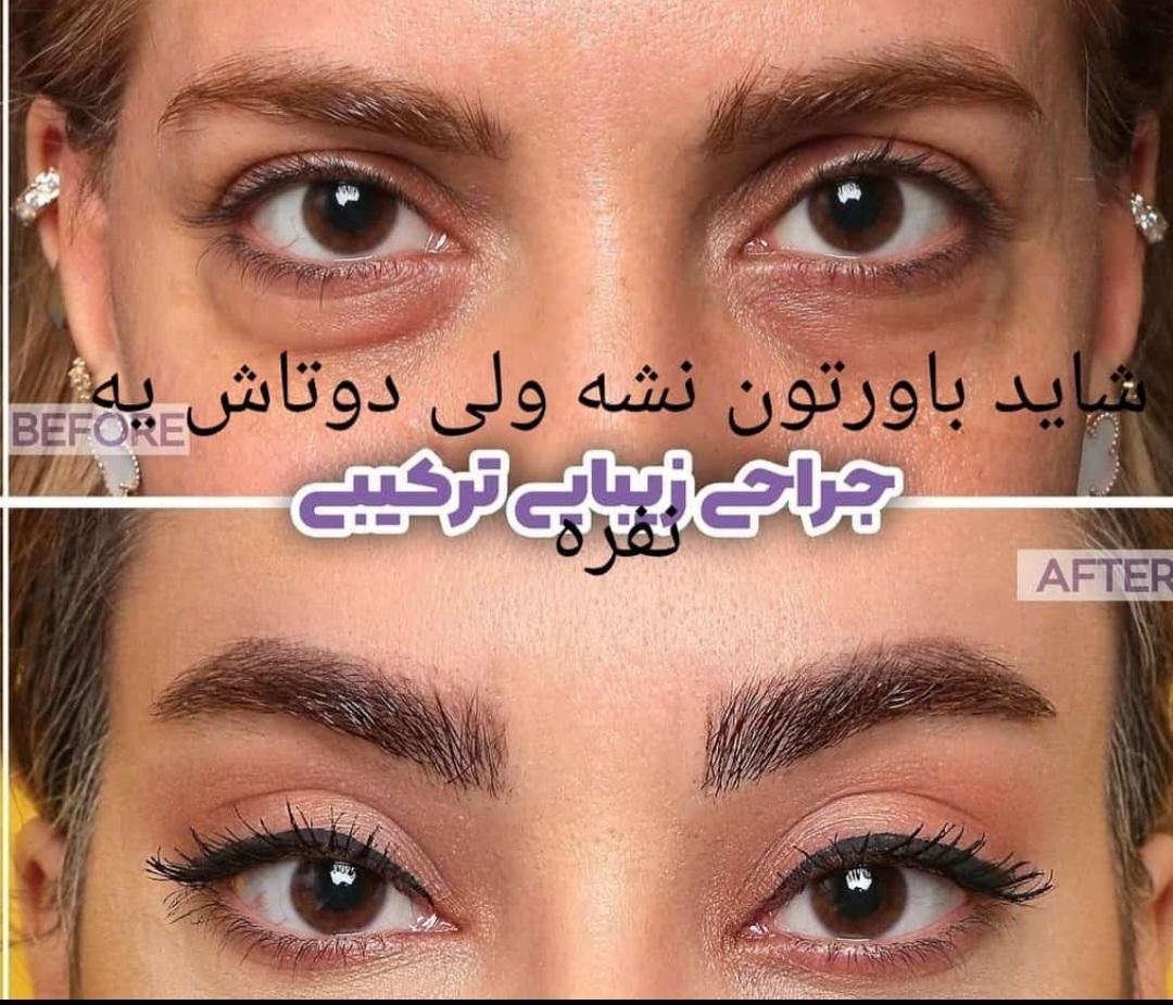 بلفاروپلاستی پلک وسانترال ودایرکت ابرو درجشنواره|خدمات آرایشگری و زیبایی|تهران, ونک|دیوار