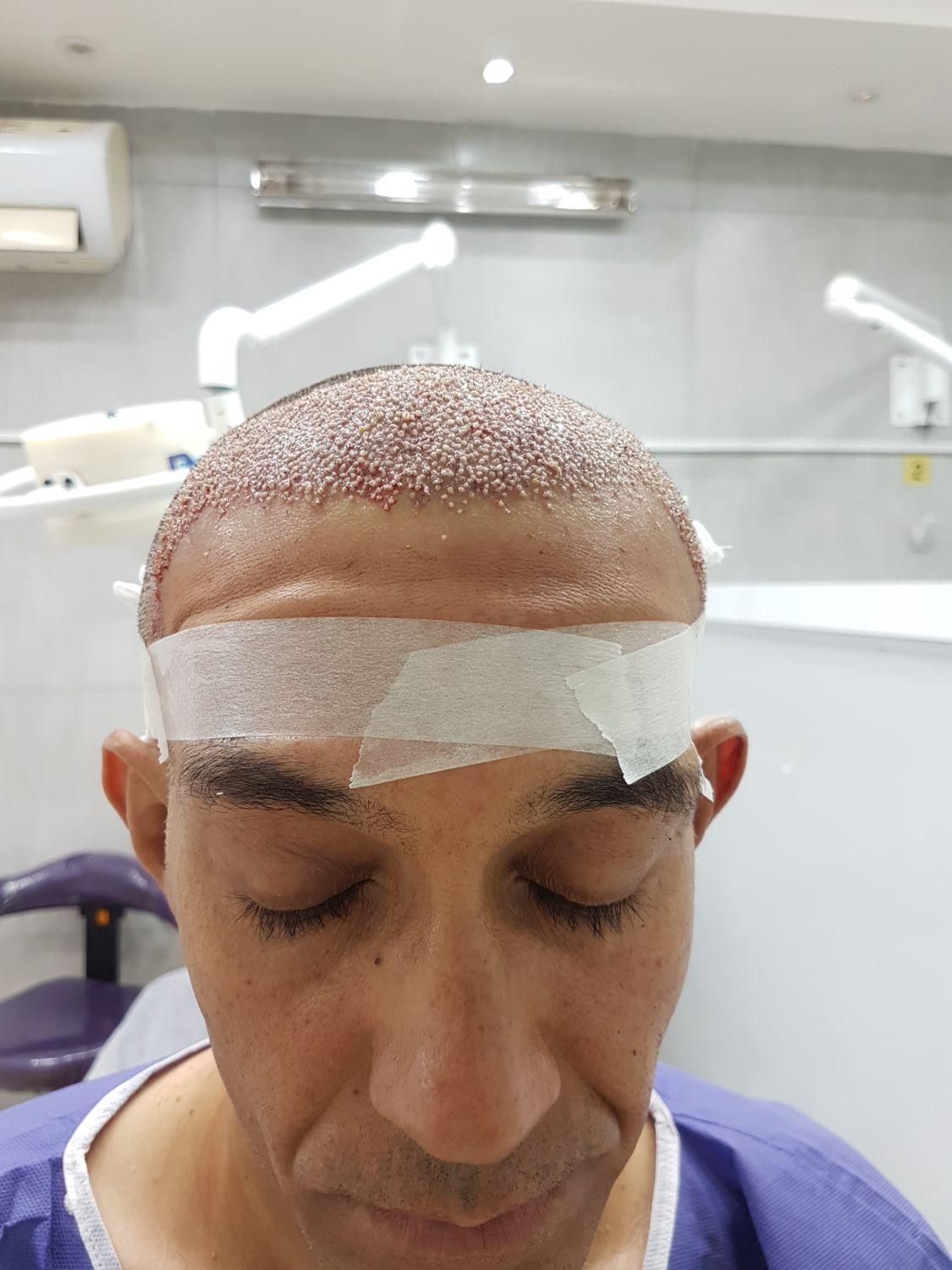 کاشت مو،کاشت ابرو و ریش تخصصی|خدمات آرایشگری و زیبایی|شیراز, قصرالدشت|دیوار