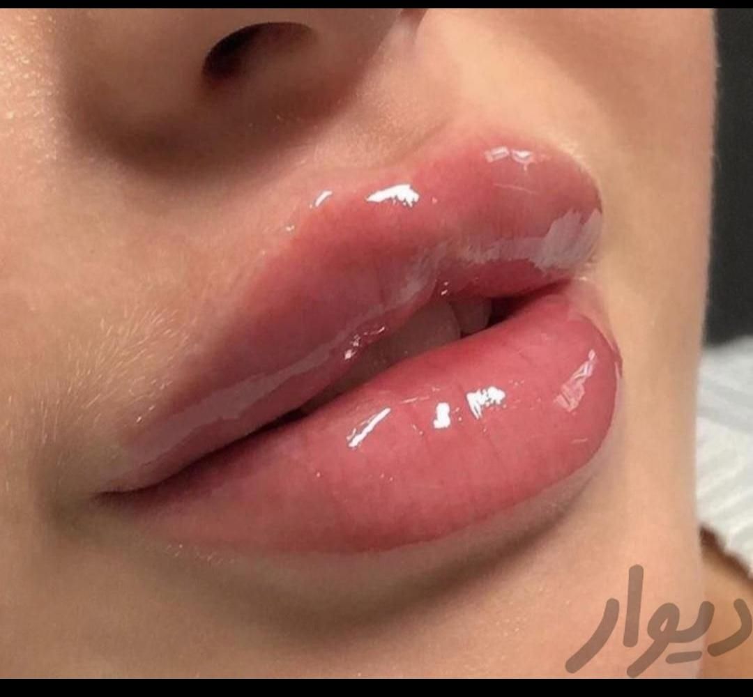 فیلر لب چانه گونه زاویه بوتاکس هایفو ژل مزو لیزر|خدمات آرایشگری و زیبایی|مشهد, فرهنگ|دیوار