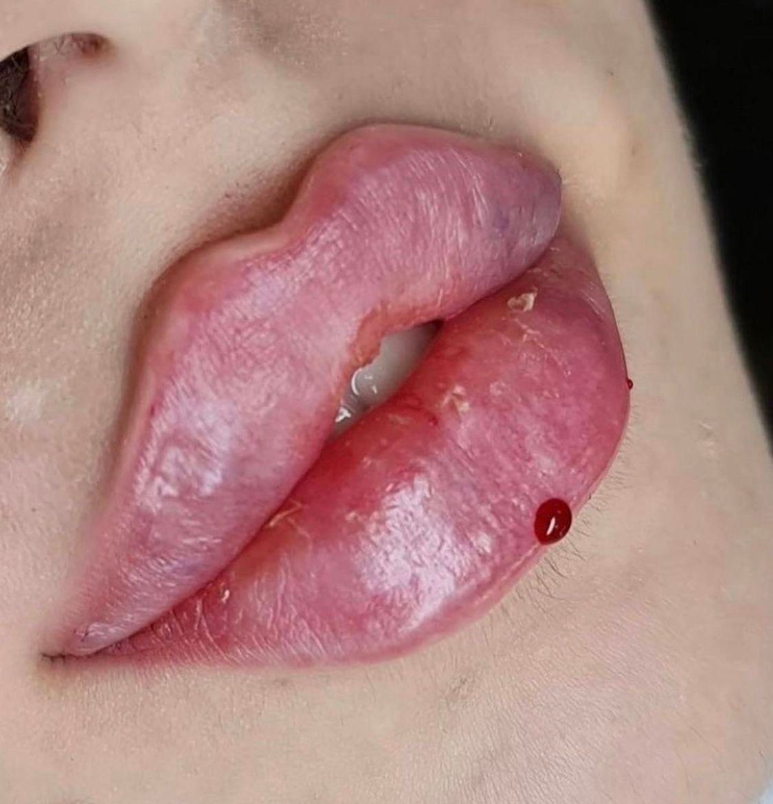 تزریق ژل لب روسی آنزیم زاویه سازی لیزر توسط پزشک|خدمات آرایشگری و زیبایی|تهران, صادقیه|دیوار