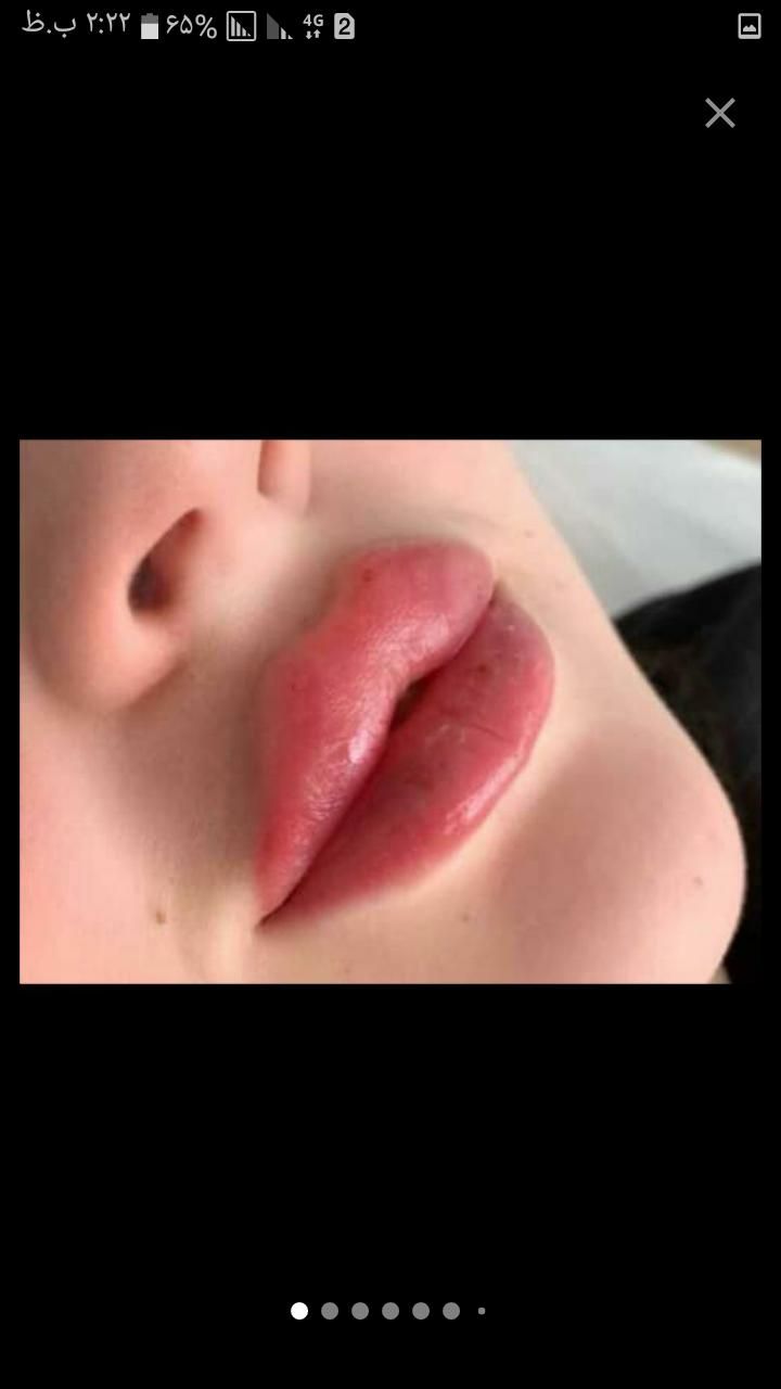 تزریق ژل وبوتاکس|خدمات آرایشگری و زیبایی|گلبهار, |دیوار