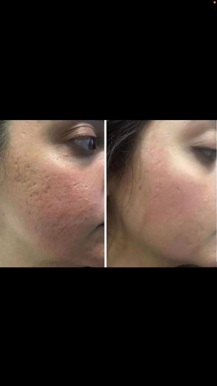 پاکسازی پوست فشیال لیزر پوست فیشیال|خدمات آرایشگری و زیبایی|شیراز, درکی|دیوار