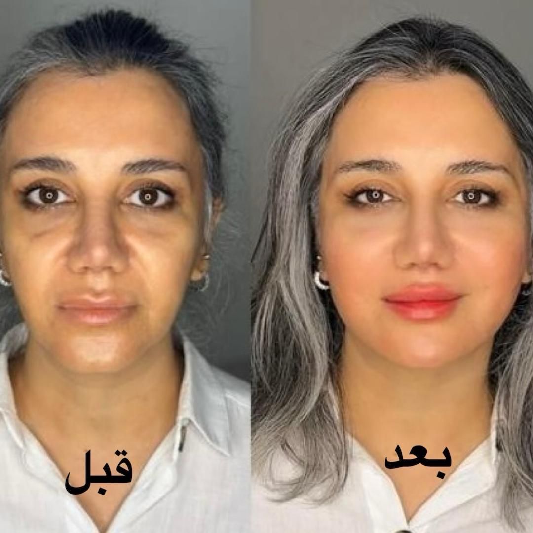 آموزش و خدمات ژل فیلر بوتاکس هایفو توسط پزشک مجرب|خدمات آرایشگری و زیبایی|شهریار, |دیوار
