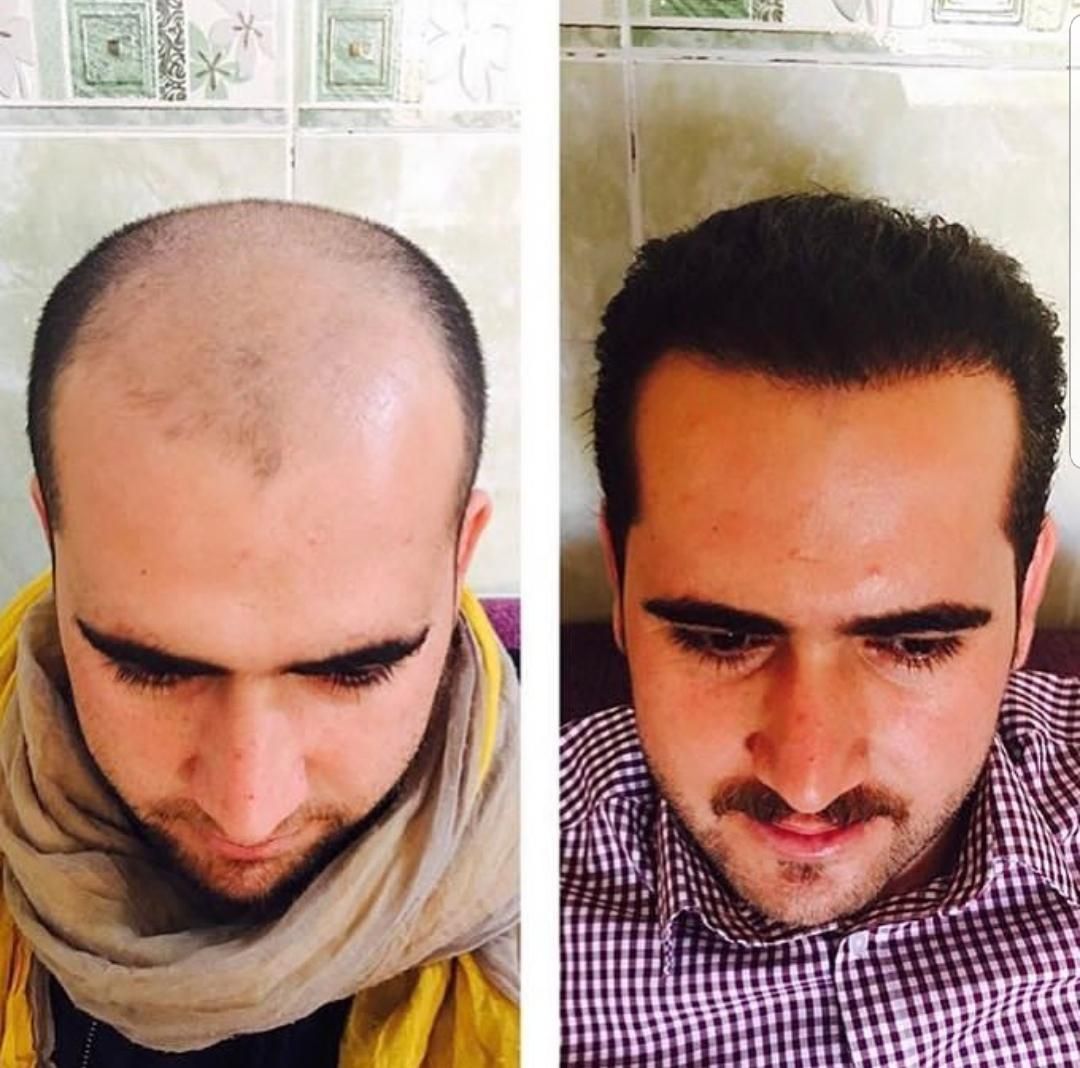 مرکز کاشت مو آتیه یزد|خدمات آرایشگری و زیبایی|یزد, |دیوار