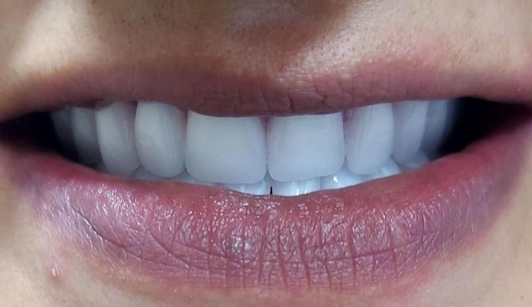 دندان مصنوعی/ دست دندان/ ژله ای/ چکی|خدمات آرایشگری و زیبایی|کرج, چهارصد دستگاه|دیوار