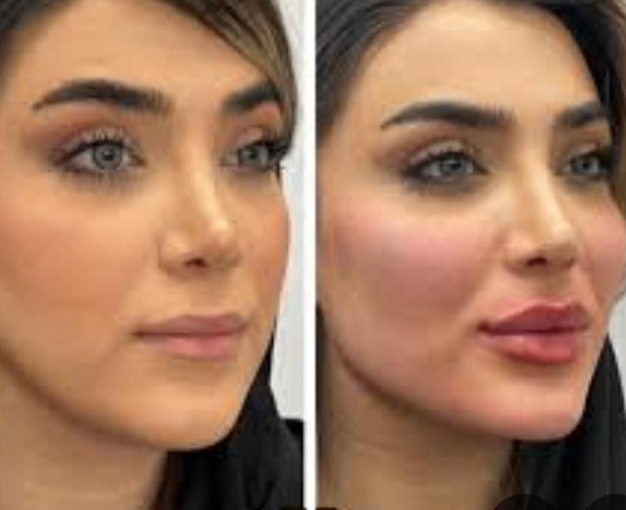 تخفیف ویژه تا ۶ شهریور  فیلربادی سینه بیکینی باسن|خدمات آرایشگری و زیبایی|تهران, دارآباد|دیوار