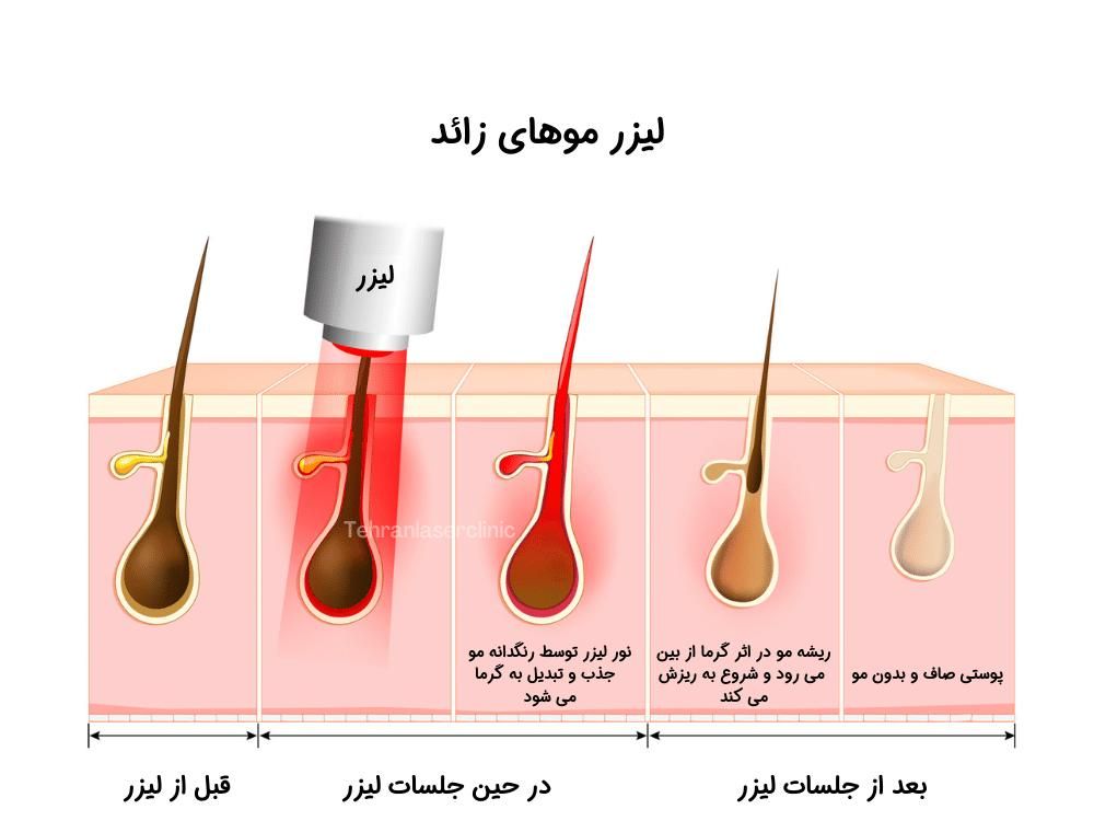 لیزر موهای زائد|خدمات آرایشگری و زیبایی|چالوس, |دیوار