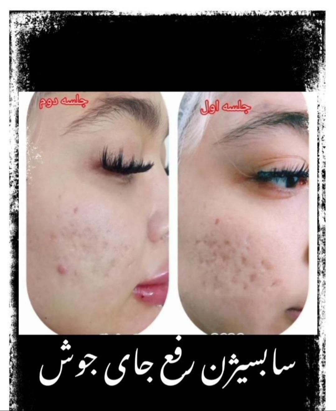 سابسیژن فیلر اندولیفت ژل بادی هایفو مزو بوتاکس|خدمات آرایشگری و زیبایی|کرج, مهرویلا جنوبی|دیوار