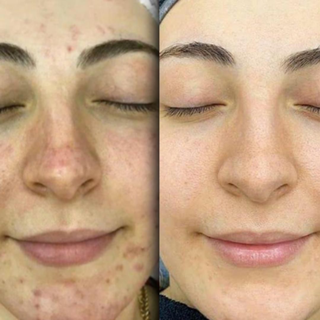 ترمیا (رفع جای جوش/جوانسازی/کلاژنسازی)|خدمات آرایشگری و زیبایی|ابهر, |دیوار