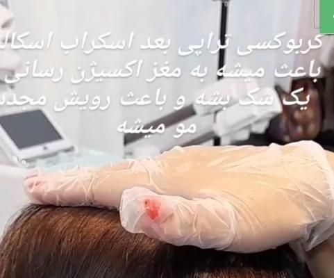 درمان ریزش مو و رشد مجدد مو فقط در چند جلسه|خدمات آرایشگری و زیبایی|قوچان, |دیوار