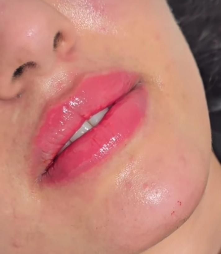 ژل وبوتاکس بلک فرایدی404(اقساط)(توسط پزشک)|خدمات آرایشگری و زیبایی|خرمآباد, |دیوار