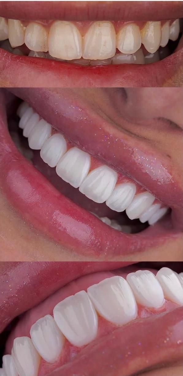 کامپوزیت دندان|خدمات آرایشگری و زیبایی|سبزوار, کاشفی شمالی (دادگستری)|دیوار