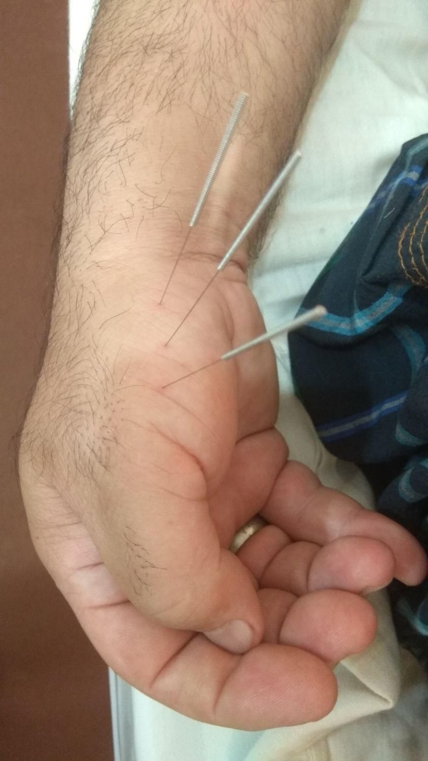 آموزش طب سوزنی ، درمان بیماریها با طب سوزنی|خدمات آموزشی|شیراز, قدوسی غربی|دیوار