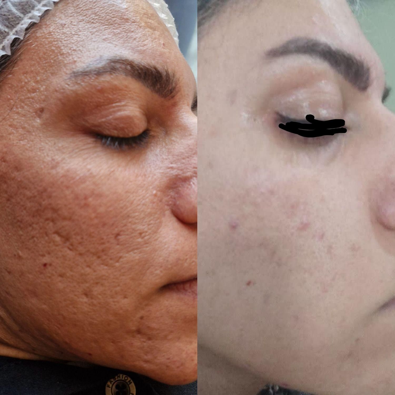 تخفیف پاکسازی پوست وفیشیال بادستگاه ومواد|خدمات آرایشگری و زیبایی|اصفهان, مولوی|دیوار