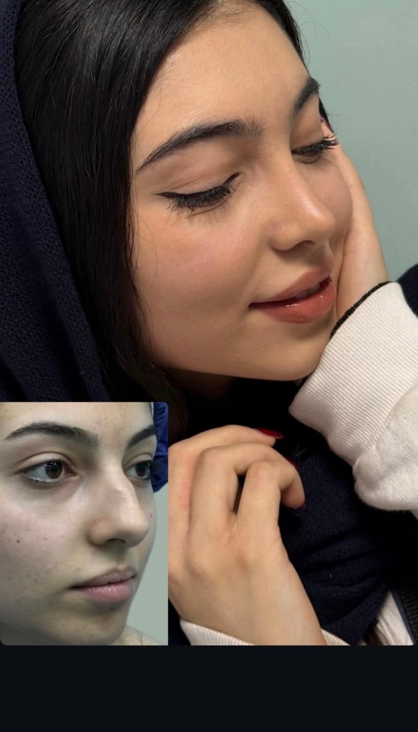 جراحی و عمل بینی/ لیفت صورت در کرج و تهران|خدمات آرایشگری و زیبایی|کرج, جهان‌شهر|دیوار