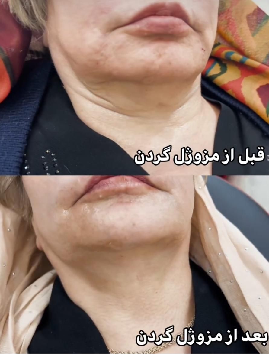 تزریق مزوژل جوانساز ویتن کُره کلینیک زیبایی|خدمات آرایشگری و زیبایی|تهران, تهرانسر شرقی|دیوار