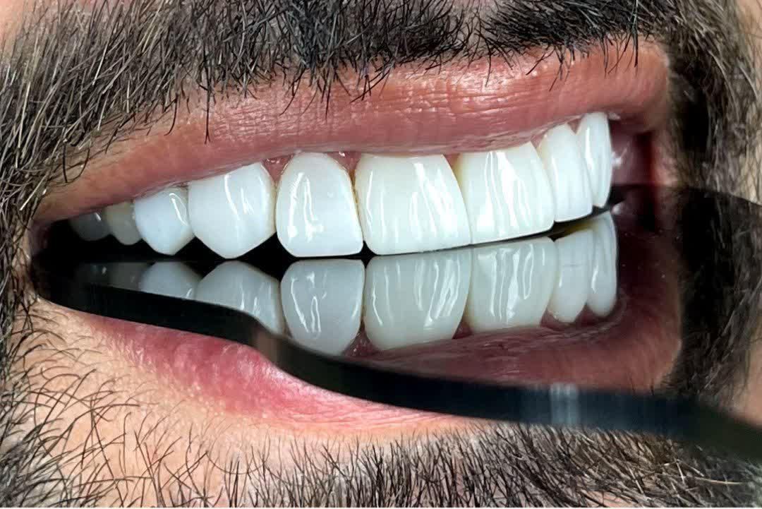 کامپوزیت دندان روکش دندان ایمپلنت کره ای اوردنچر|خدمات آرایشگری و زیبایی|تهران, ستارخان|دیوار