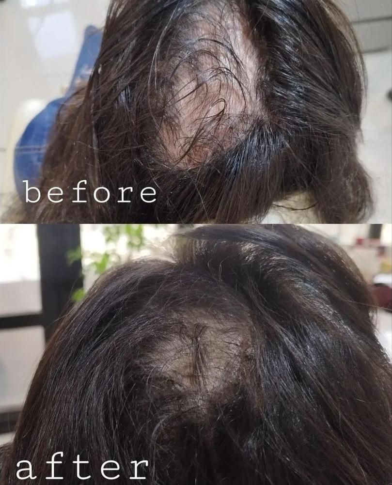 تزریق ژل لب و گونه و چانه و..(جشنواره)درمطب|خدمات آرایشگری و زیبایی|اصفهان, ملک‌شهر|دیوار