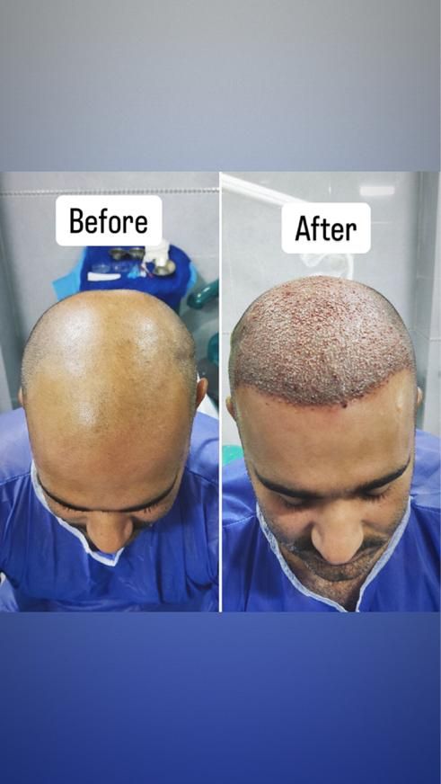 کاشت مو و ابرو و انجام بوتاکس و مزوتراپی و PRP|خدمات آرایشگری و زیبایی|قزوین, |دیوار