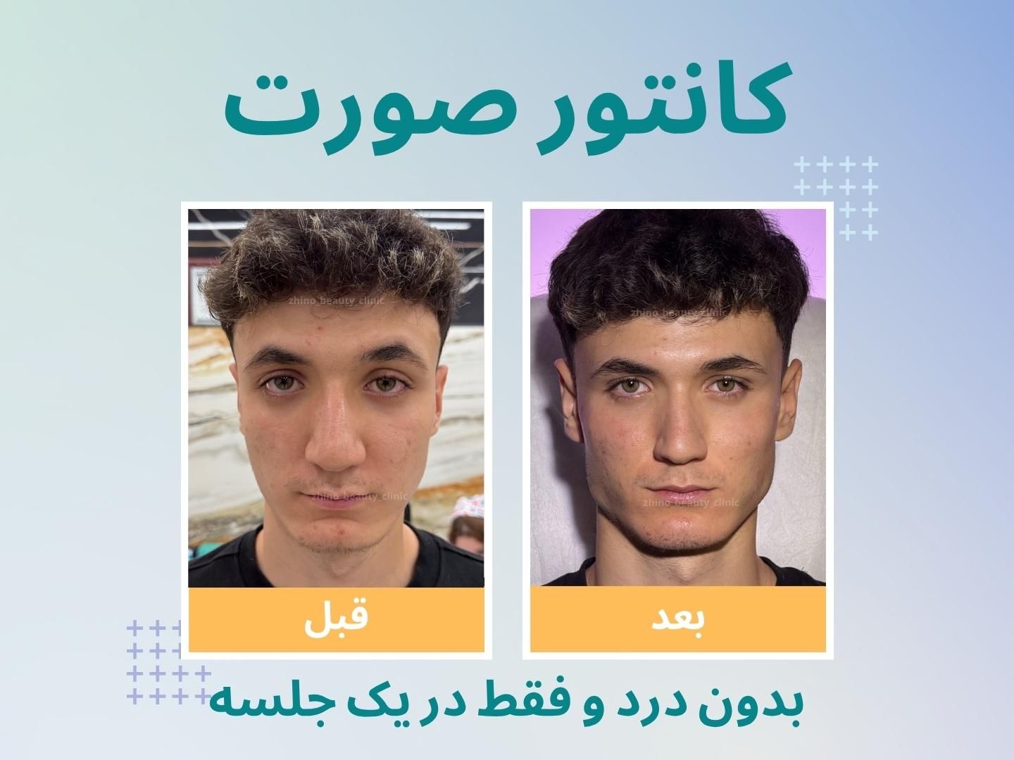 زاویه سازی صورت/فیلر و نانو فت/ در یک جلسه|خدمات آرایشگری و زیبایی|تهران, دروس|دیوار