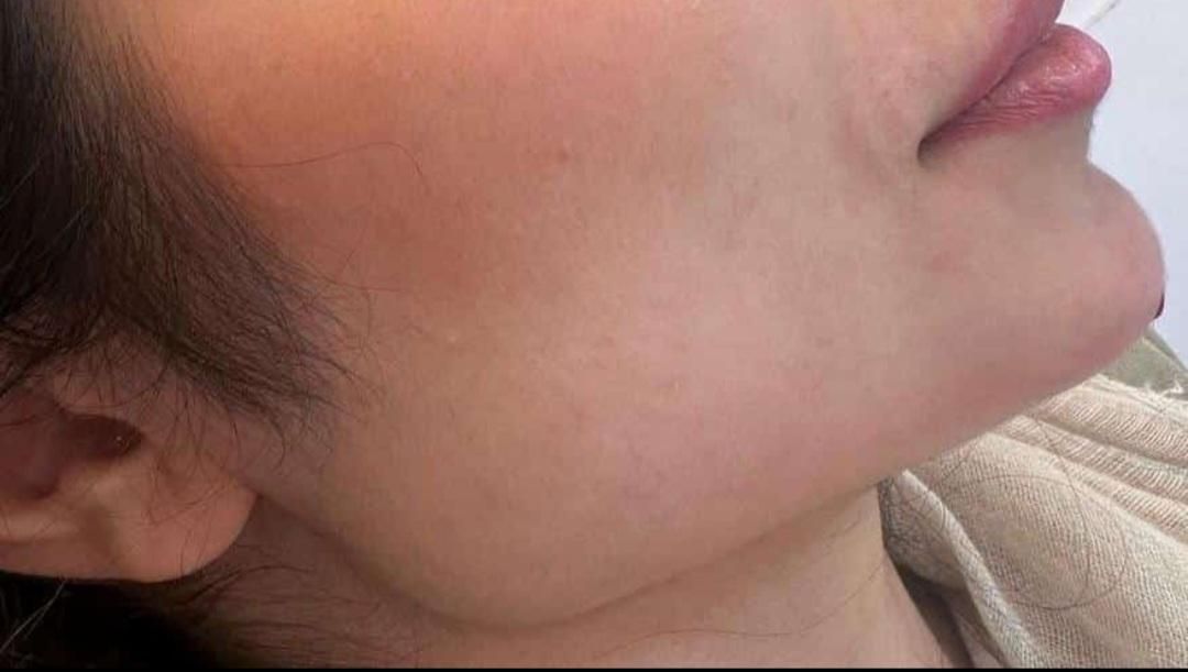 فیلر،ژل بوتاکس،آنزیم،فیلر بادی،پیرسینگ|خدمات آرایشگری و زیبایی|شیراز, میرزاکوچک خان|دیوار