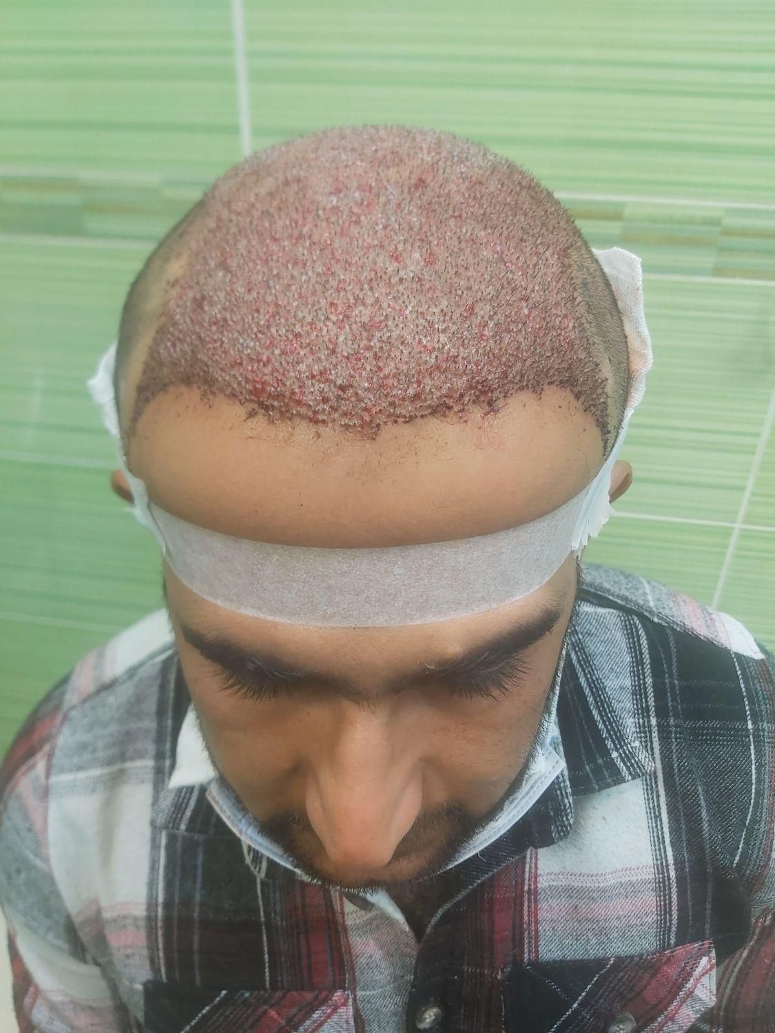 کاشت مو|خدمات آرایشگری و زیبایی|شیراز, قصرالدشت|دیوار