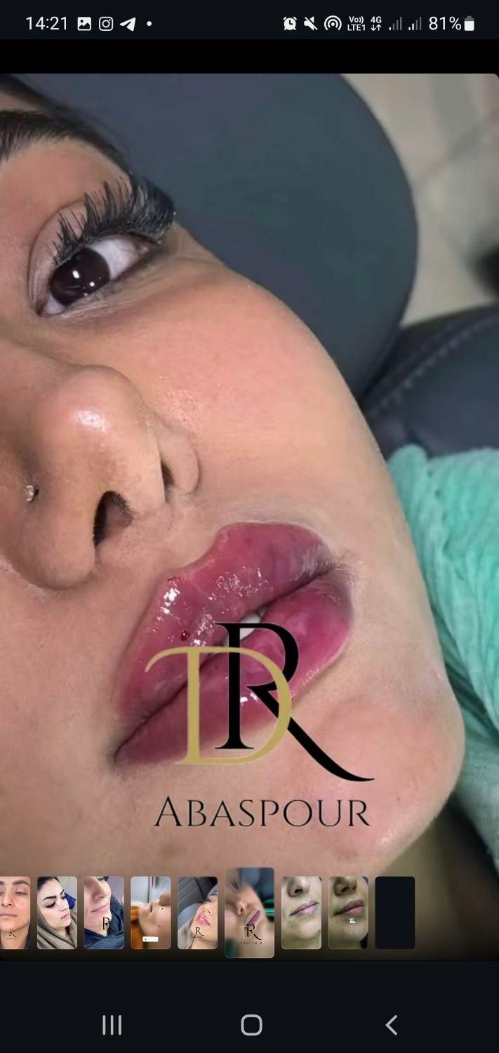 جشنواره ژل و بوتاکس|خدمات آرایشگری و زیبایی|اصفهان, مرداویج|دیوار