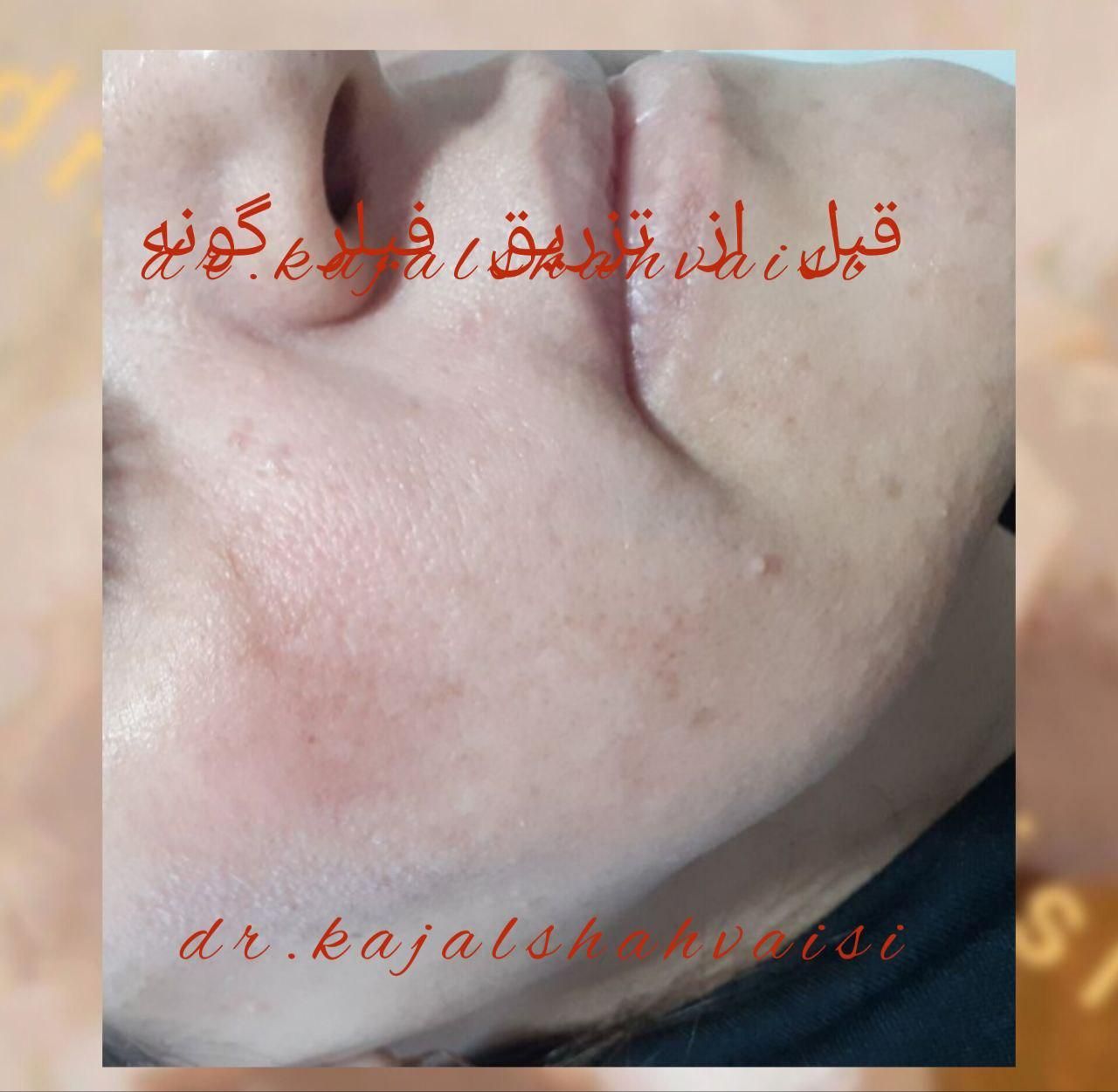 تزریق تخصصی ژل بوتاکس و جوانساز در مطب خانم دکتر|خدمات آرایشگری و زیبایی|سنندج, |دیوار
