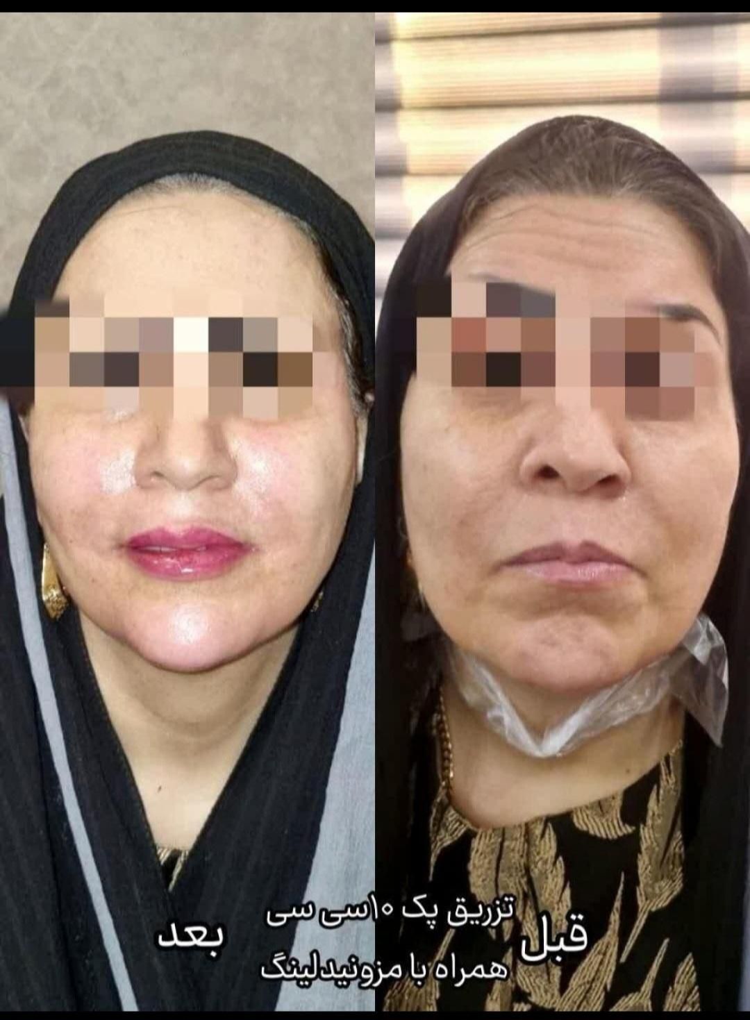 پوست صاف ویکدست میخوای متن آگهی روبخون+پیشنهادویژه|خدمات آرایشگری و زیبایی|قم, باجک دو|دیوار