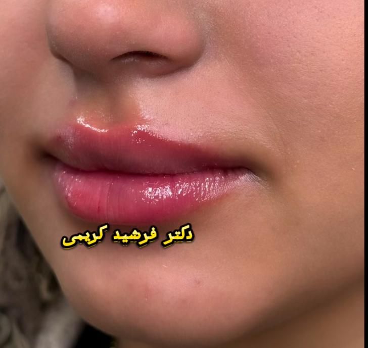 بوتاکس مصپورت فقط۴۹۰ کلینیک زیبایی دکتر فرشیدکریمی|خدمات آرایشگری و زیبایی|کرمانشاه, |دیوار