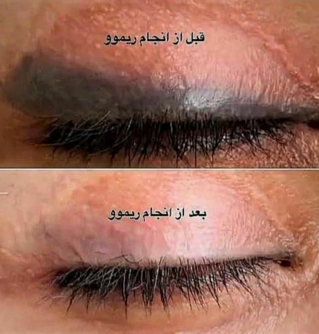 لیزرموهای زائد، تیتانیوم ،پاک کردن تتو،کیوسوئیچ|خدمات آرایشگری و زیبایی|اصفهان, نقش جهان|دیوار