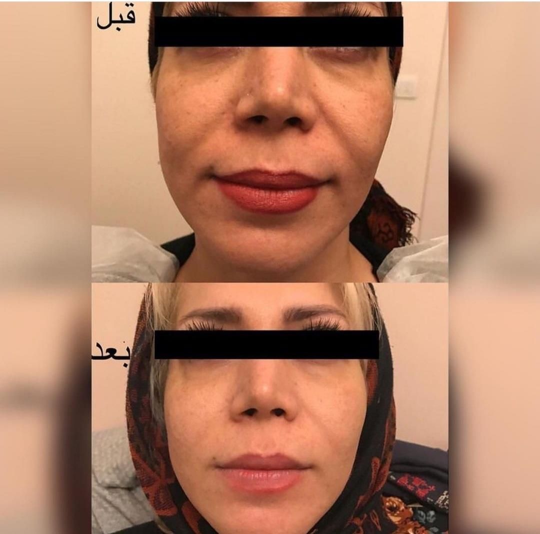 هایفوتراپی جوانسازی لیفت صورت غبغب آف به مدت محدود|خدمات آرایشگری و زیبایی|قم, شهرک قدس|دیوار
