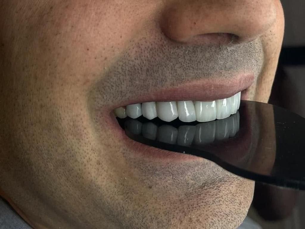 جشنواره کامپوزیت دندان|خدمات آرایشگری و زیبایی|فردیس, فردیس|دیوار