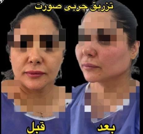 بوتاکس بلفارو لابیا تزریق‌ ژل نازی اباد‌ ستارخان|خدمات آرایشگری و زیبایی|تهران, نازی‌آباد|دیوار