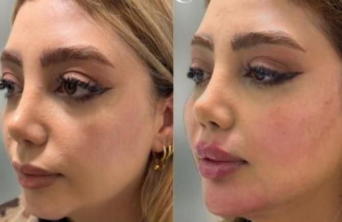 اموزش پزشک متخصص ژل.فیلر‌بوتاکس.لیفت نخ.ساکشن غبغب|خدمات آموزشی|مشهد, سناباد|دیوار