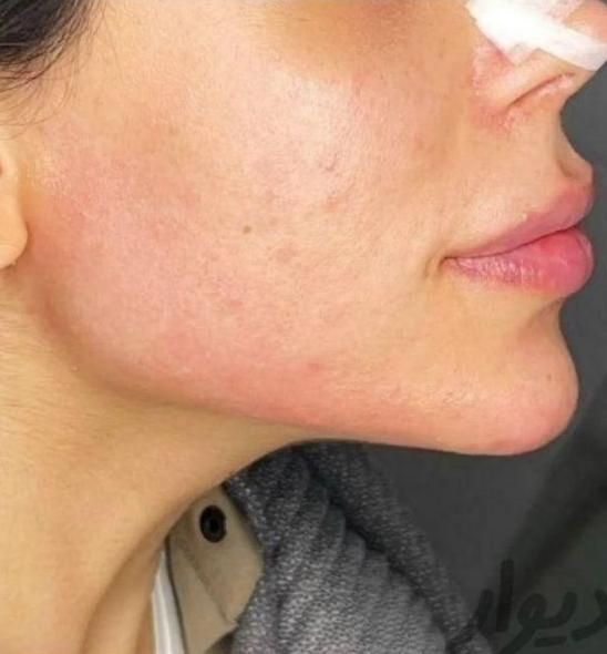 تزریق ژل و بوتاکس و فیلر زیر چشم ،نخ ،مزو ، آنزیم|خدمات آرایشگری و زیبایی|کرج, گوهردشت|دیوار