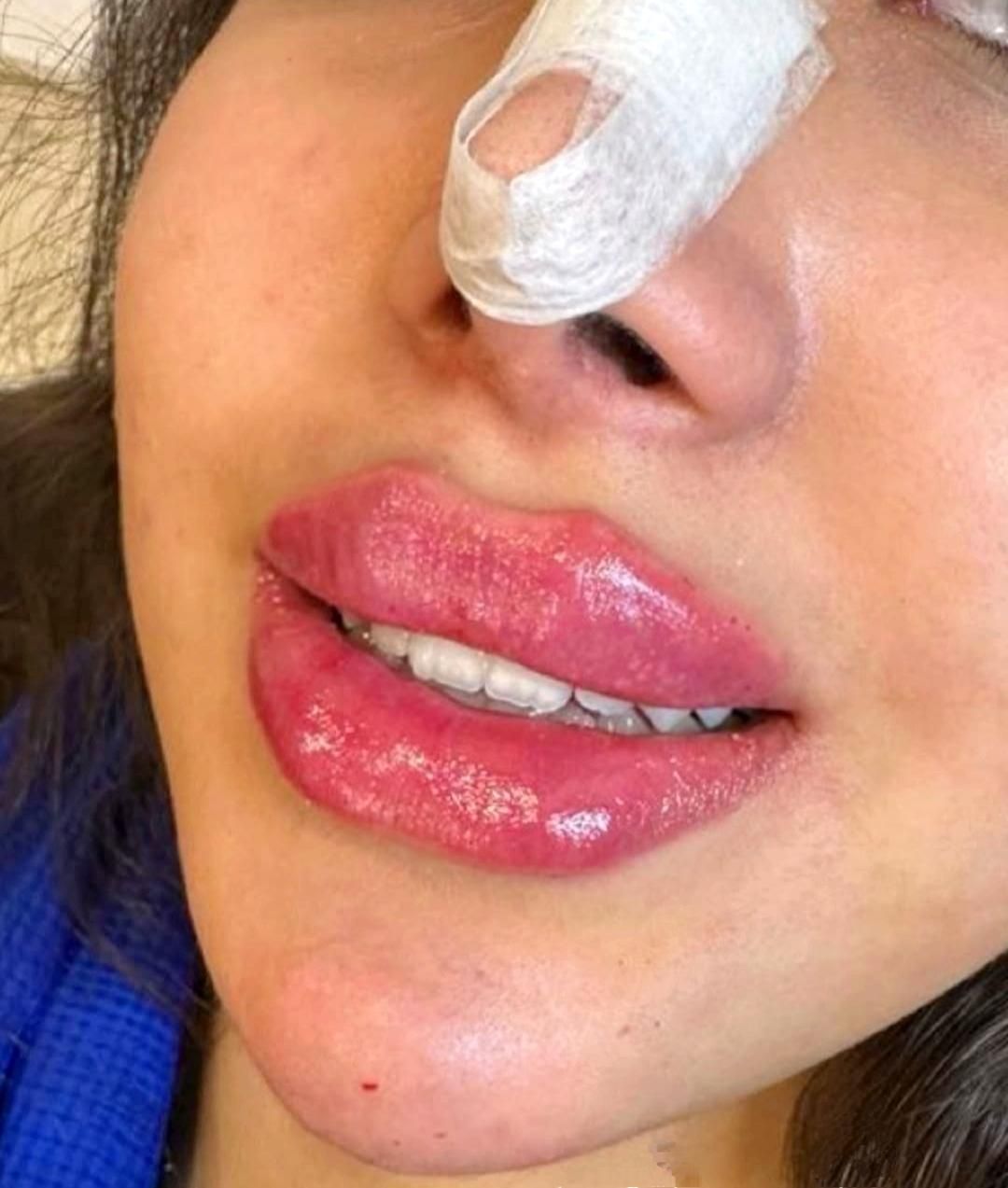 تزریق فیلر صورت مطابق المانهای زیبایی شناسی|خدمات آرایشگری و زیبایی|ورامین, |دیوار