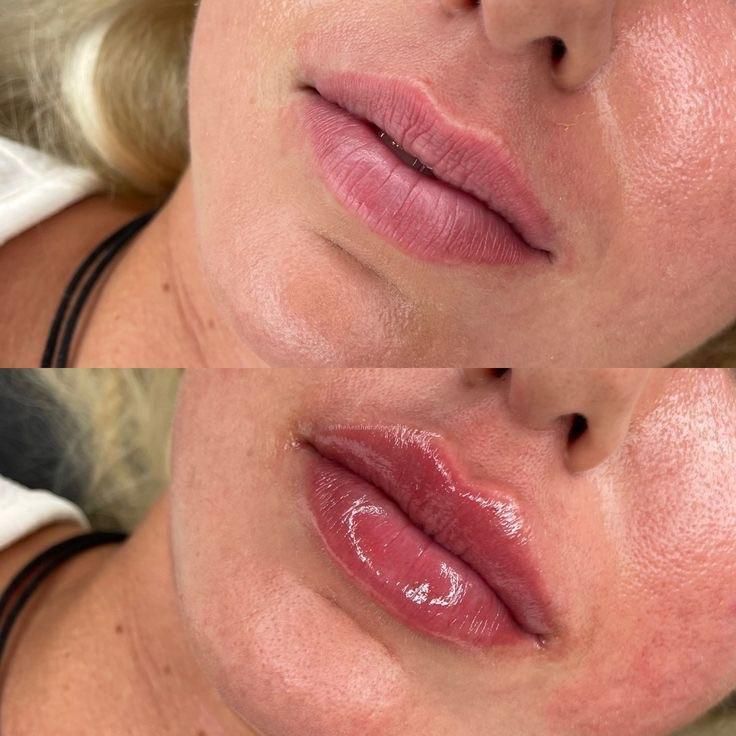مادلینگ صورت،بوتاکس،لب روسی بانوان و آقایان|خدمات آرایشگری و زیبایی|تهران, توحید|دیوار