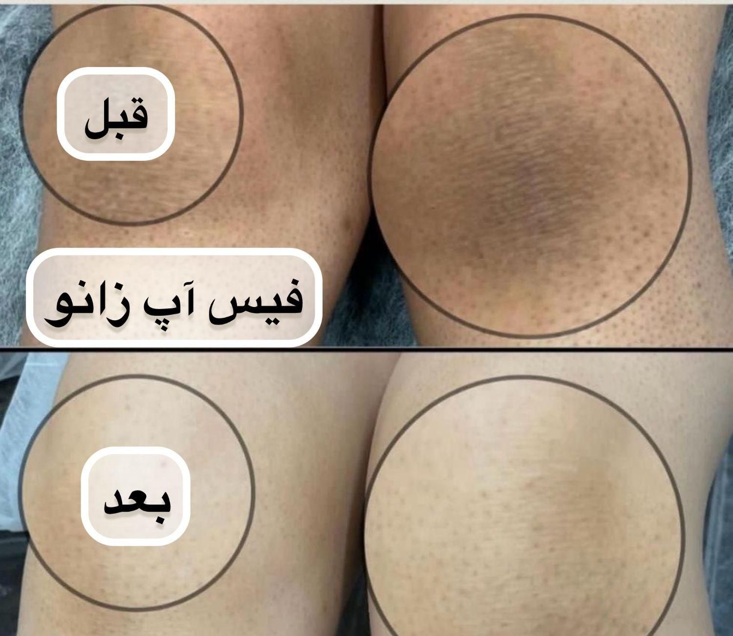 رفع تیرگی بدن در مطب پزشکی با دستگاه|خدمات آرایشگری و زیبایی|شیراز, قدوسی غربی|دیوار