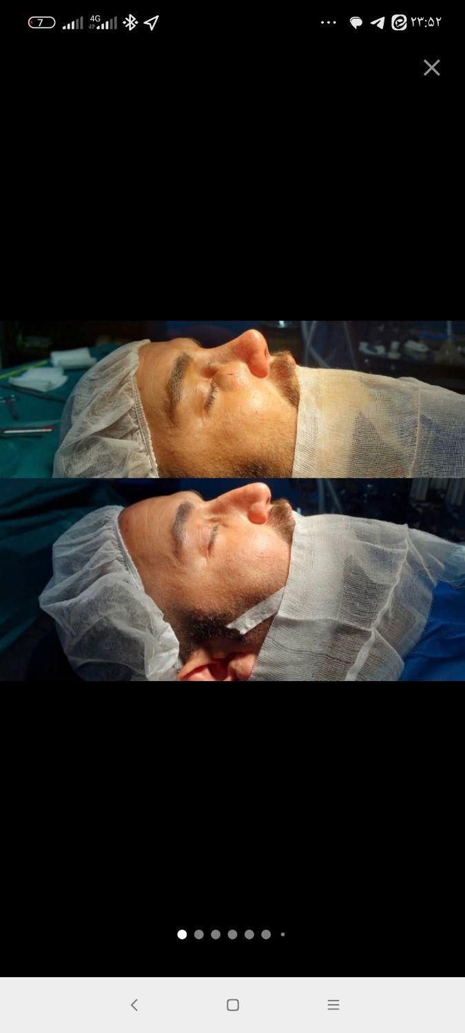 جراحی رینوپلاستی۲۷زیبایی بینی|خدمات آرایشگری و زیبایی|قم, بلوار امین و ساحلی|دیوار