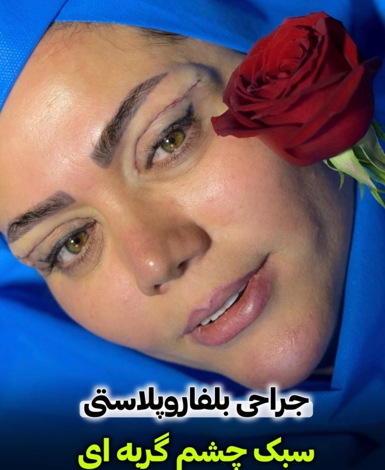 جراحی تخصصی بلفاروپلاستی با تکنیک جدید|خدمات آرایشگری و زیبایی|تهران, پاسداران|دیوار