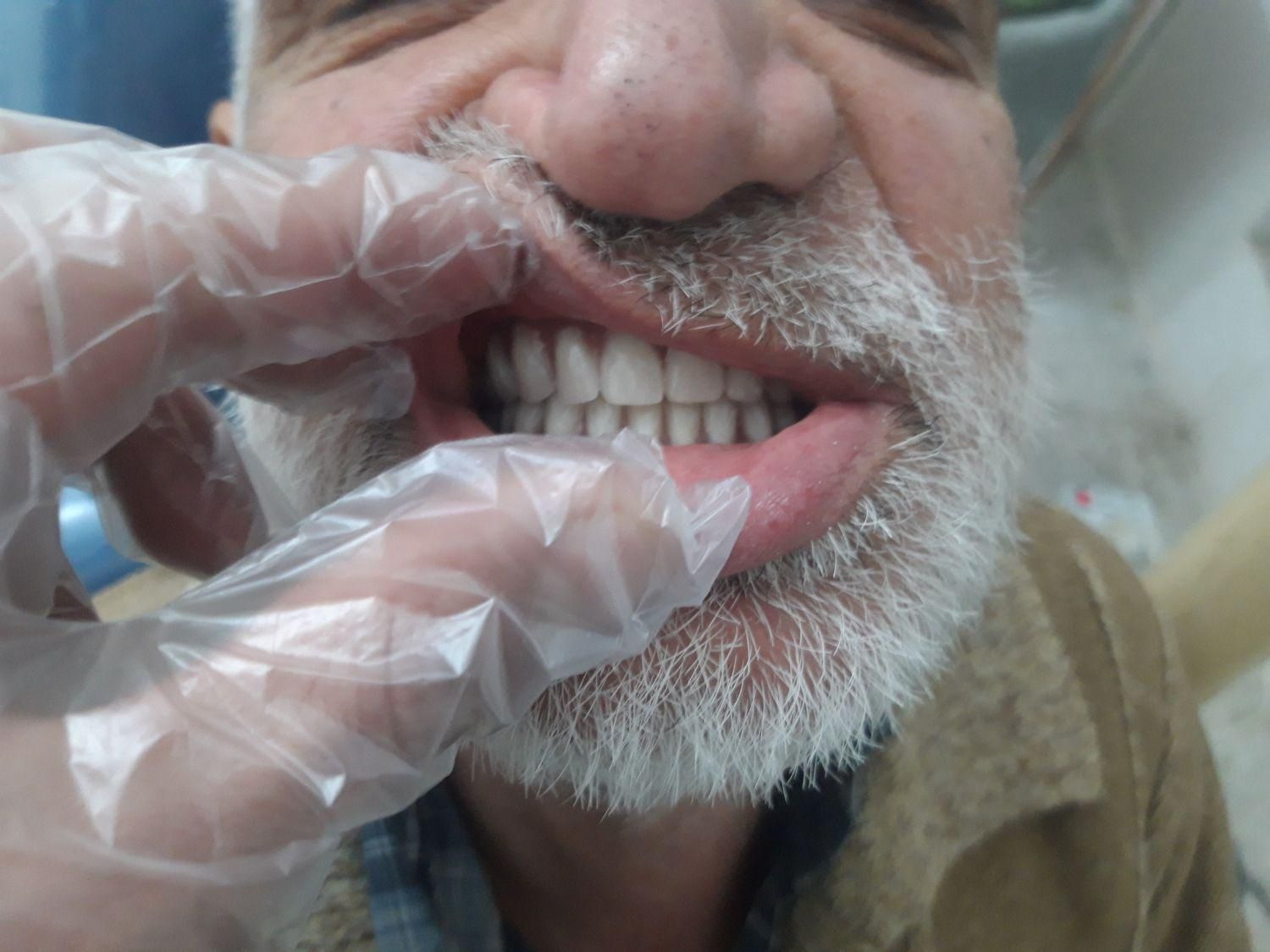 دندان مصنوعی متحرک (تحویل ۳ روزه)|خدمات آرایشگری و زیبایی|کرمانشاه, |دیوار