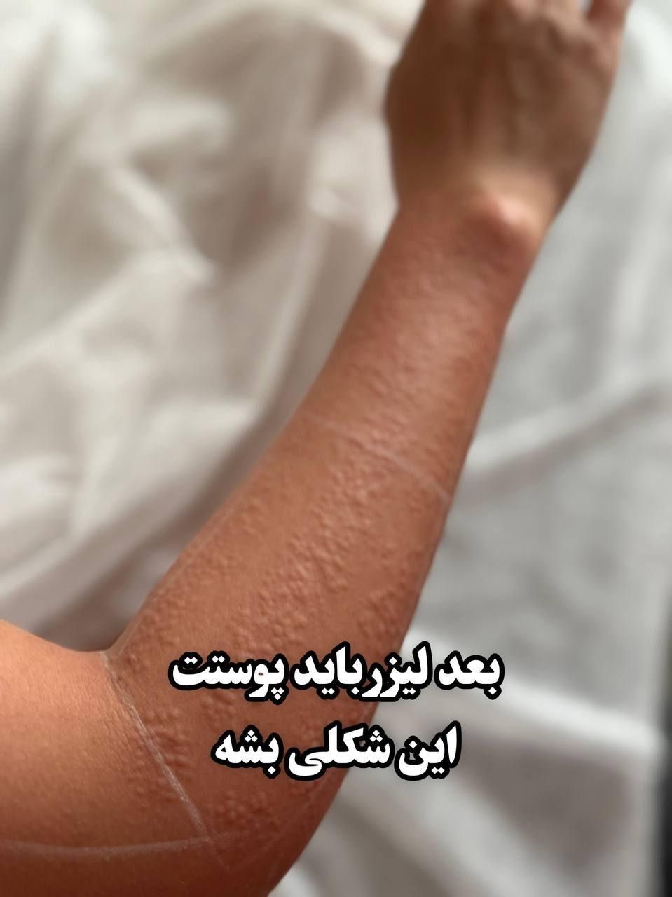 مطب لیزر موهای زائد الکس گرویتی کندلا ملاصدرا|خدمات آرایشگری و زیبایی|تهران, ونک|دیوار