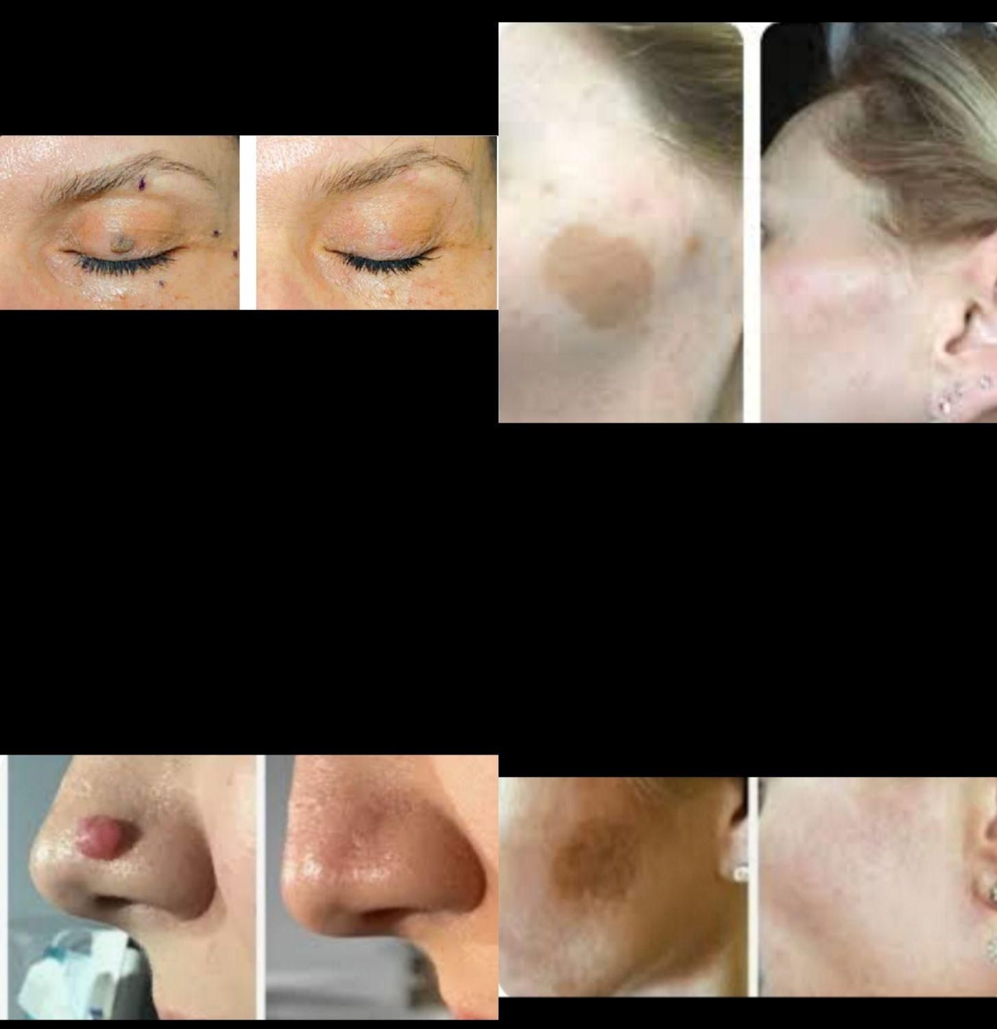 برداشتن انواع خال لک زیگیل تناسلی و...|خدمات آرایشگری و زیبایی|اصفهان, شهرک کوثر|دیوار