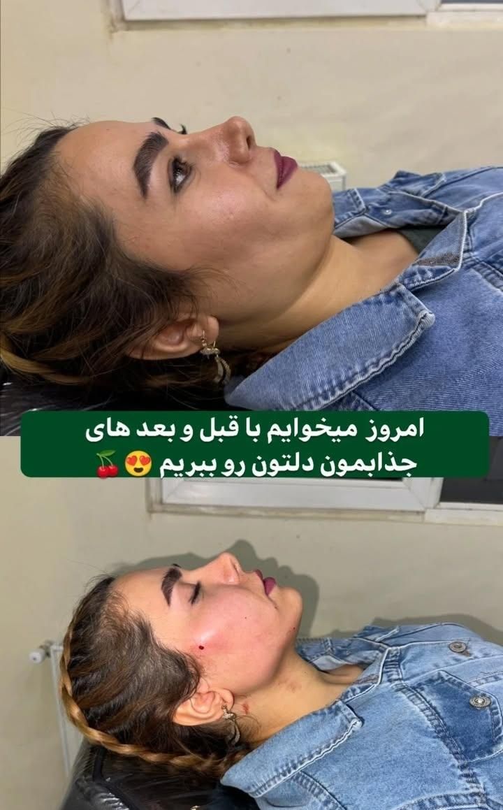 تزریق چربی فیلربادی تزریق ژل در مطب پزشک|خدمات آرایشگری و زیبایی|کرمانشاه, |دیوار