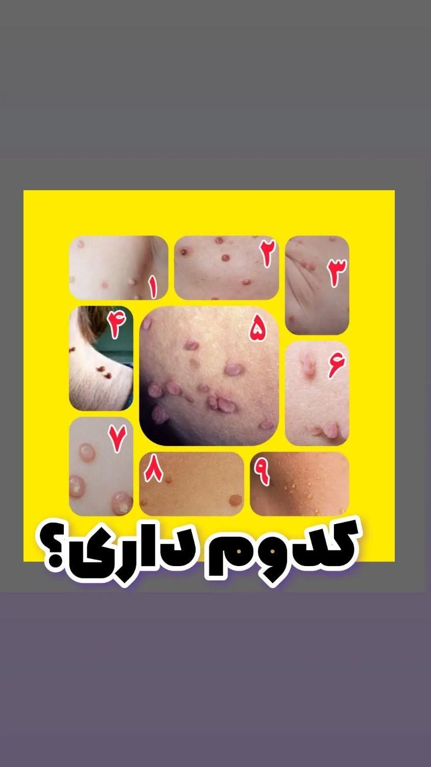 درمان زگیل و تبخال تناسلی ...باروشی نوین و ریشه ای|خدمات آرایشگری و زیبایی|خرم‌آباد, |دیوار