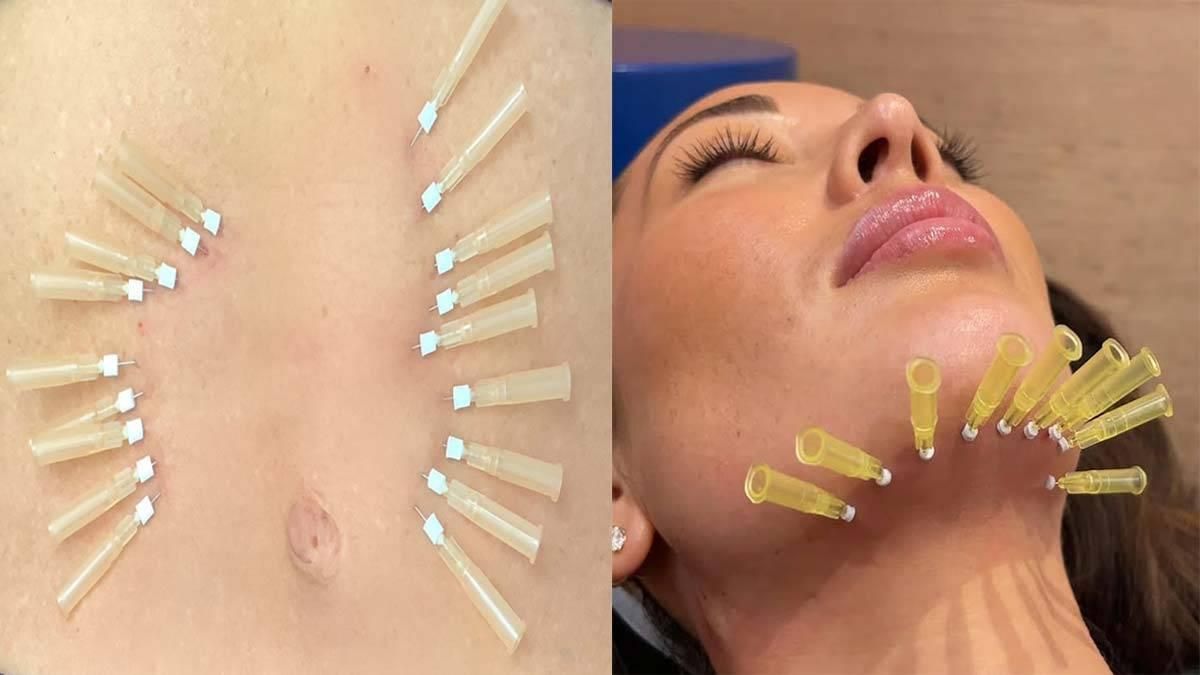 کارگاه آموزش جوانسازی پوست و لیفت با نخ-امبدینگ|خدمات آموزشی|تهران, فلسطین (میدان انقلاب)|دیوار