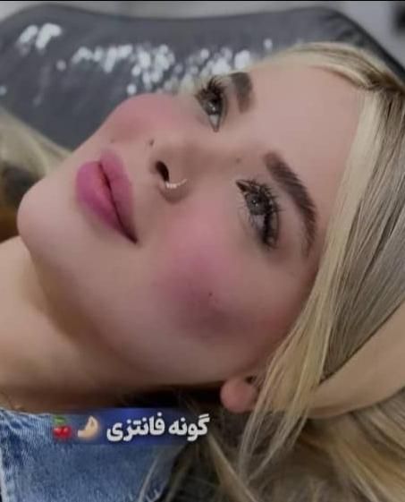 ژل بوتاکس آنزیم مطب پزشک|خدمات آرایشگری و زیبایی|کرج, عظیمیه|دیوار